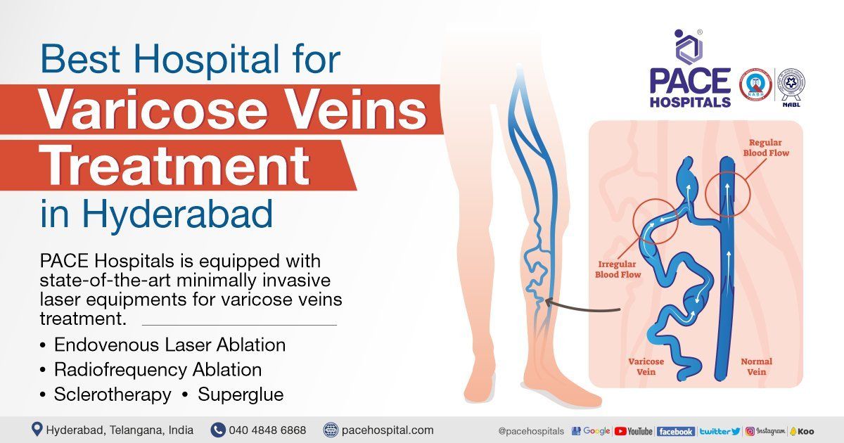 Best Hospital for Varicose Veins Treatment in Hyderabad- Surgery, Cost