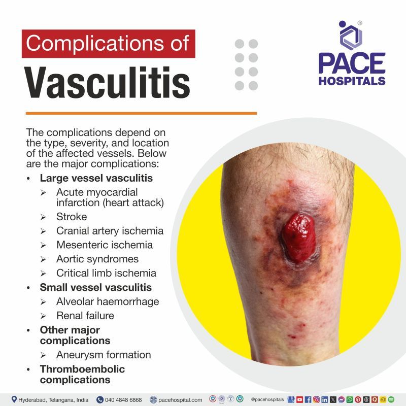 Vasculitis Complications Vasculitis Complications | Complications of Vasculitis