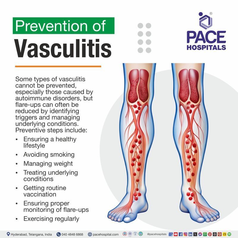 Vasculitis Prevention How to prevent vasculitis | Vasculitis prevention