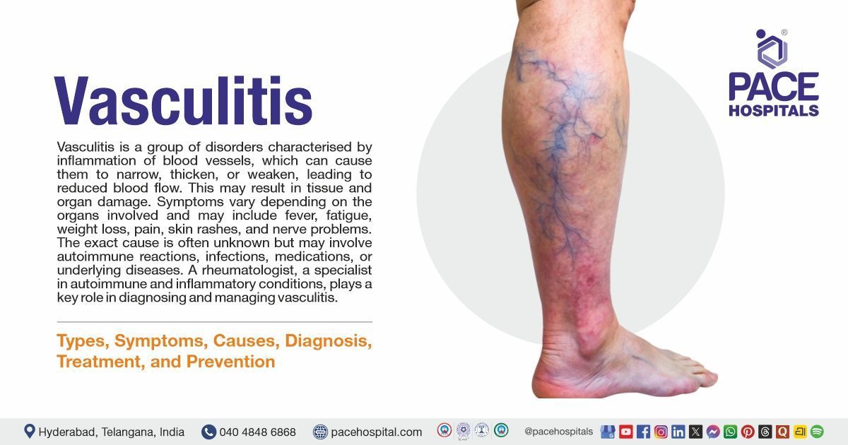 Vasculitis - Symptoms, Causes, Diagnosis, Treatment & Prevention | What is Vasculitis