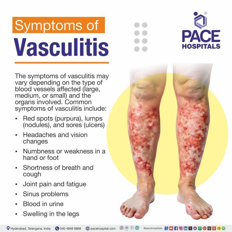 Vasculitis Symptoms Vasculitis Symptoms | Vasculitis signs and symptoms | Vasculitis symptoms pictures
