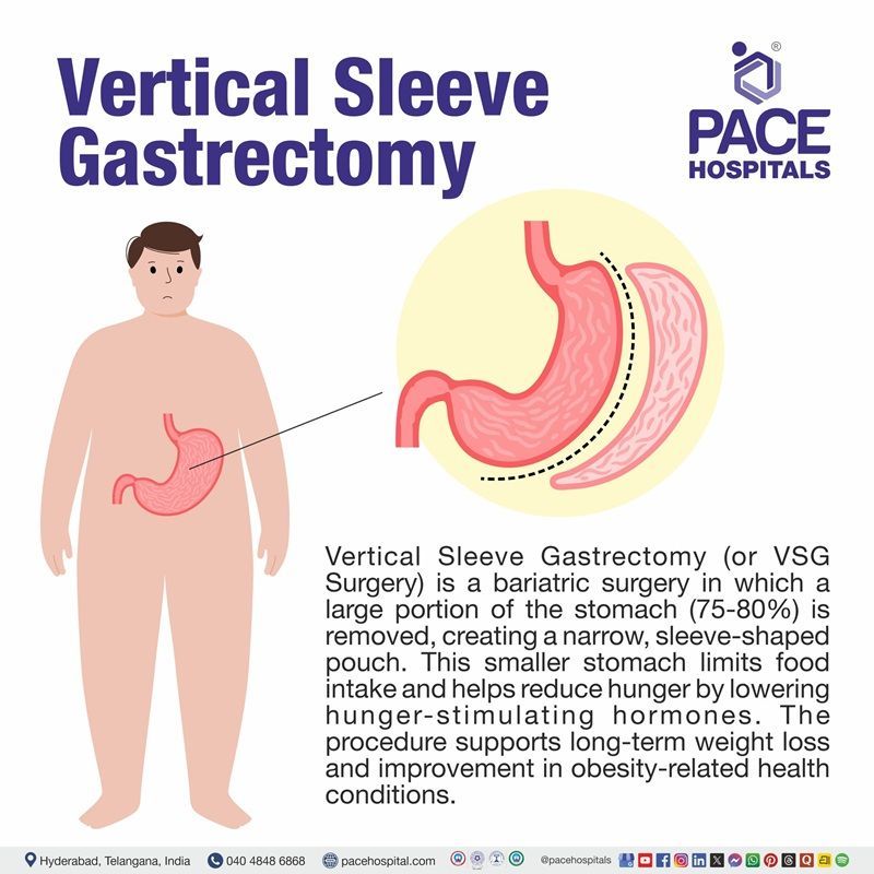 What is a sleeve gastrectomy​ | What is vertical sleeve gastrectomy (VSG) 