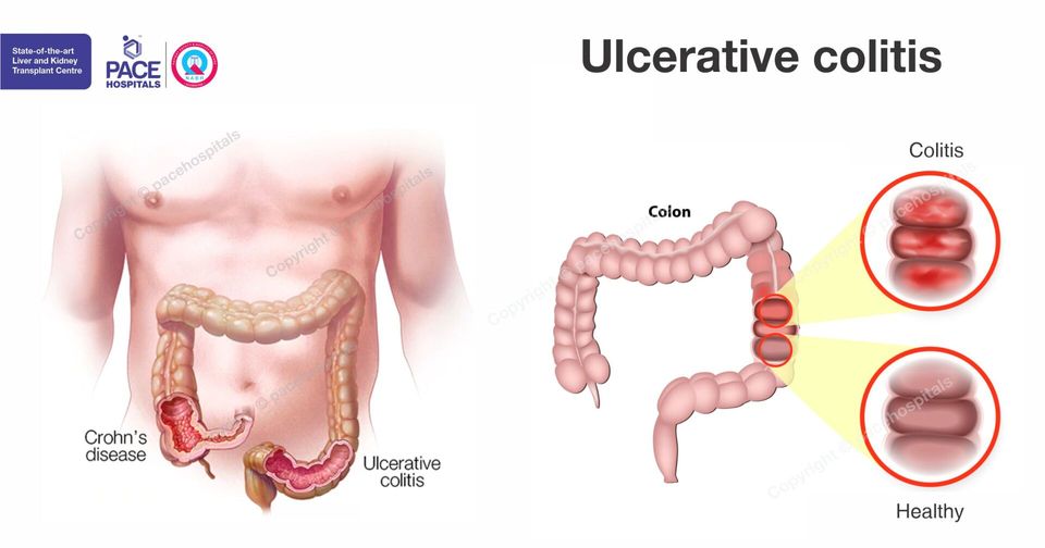 Ulcerative Colitis Causes Symptoms Complications And Treatment 8378