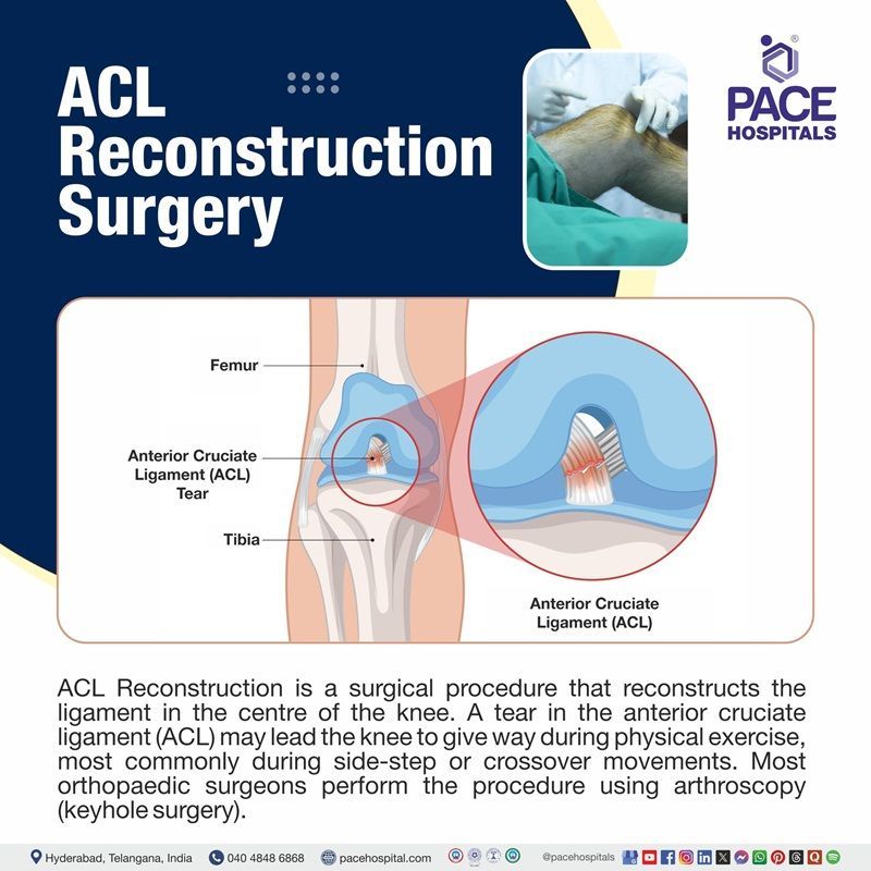 What is ACL Reconstruction Surgery​ | ACL Reconstruction Meaning​ | Arthroscopic ACL Reconstruction​
