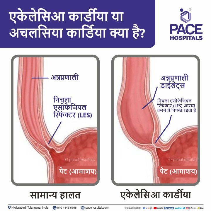 achalasia cardia in hindi