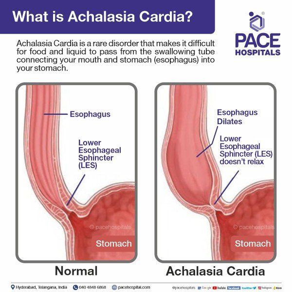 achalasia cardia definition - pathophysiology