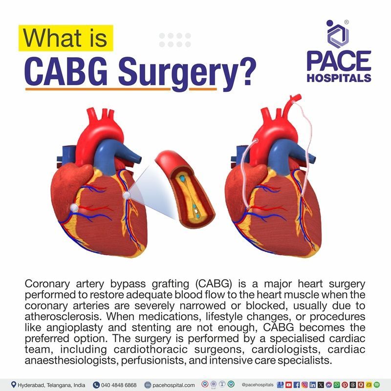 What is CABG Surgery? What is coronary artery bypass surgery (CABG)? | CABG Procedure