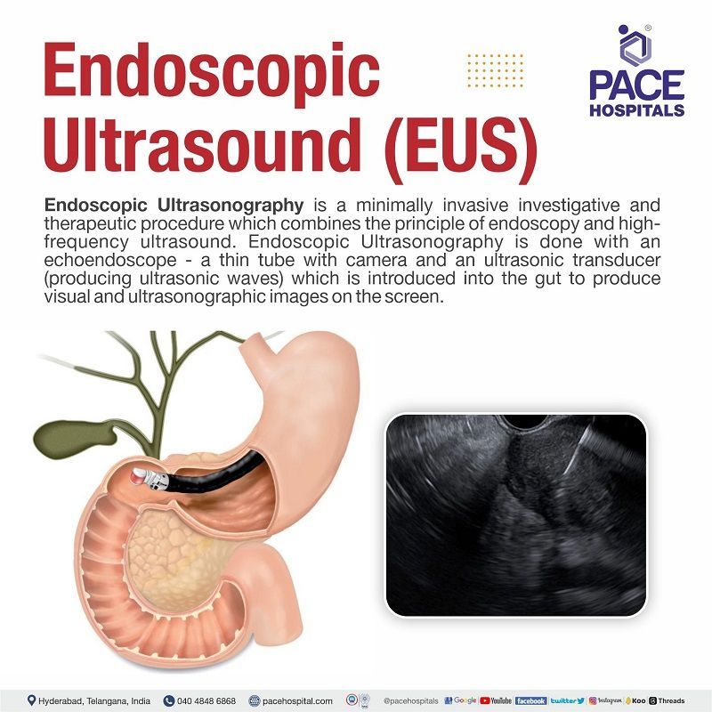 Endoscopic Ultrasound - EUS procedure in Hyderabad, India | eus test cost | Best hospital for EUS procedure | endoscopic ultrasound price