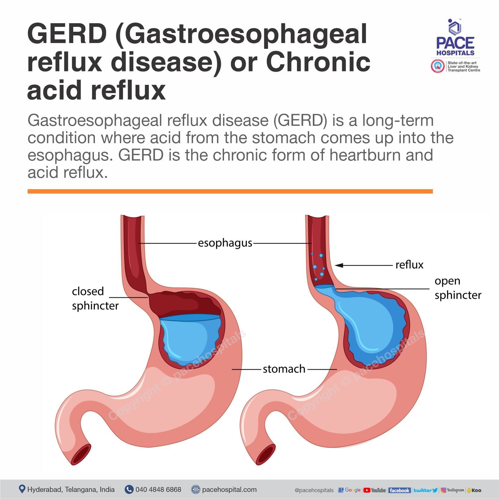 What is GERD (Gastroesophageal reflux disease) or chronic acid reflux