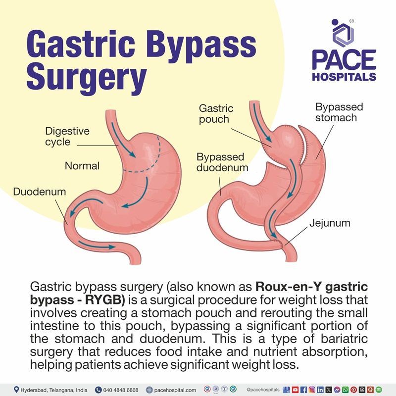Roux en y gastric bypass​ | Knee Arthroplasty​ | Gastric bypass surgery procedure