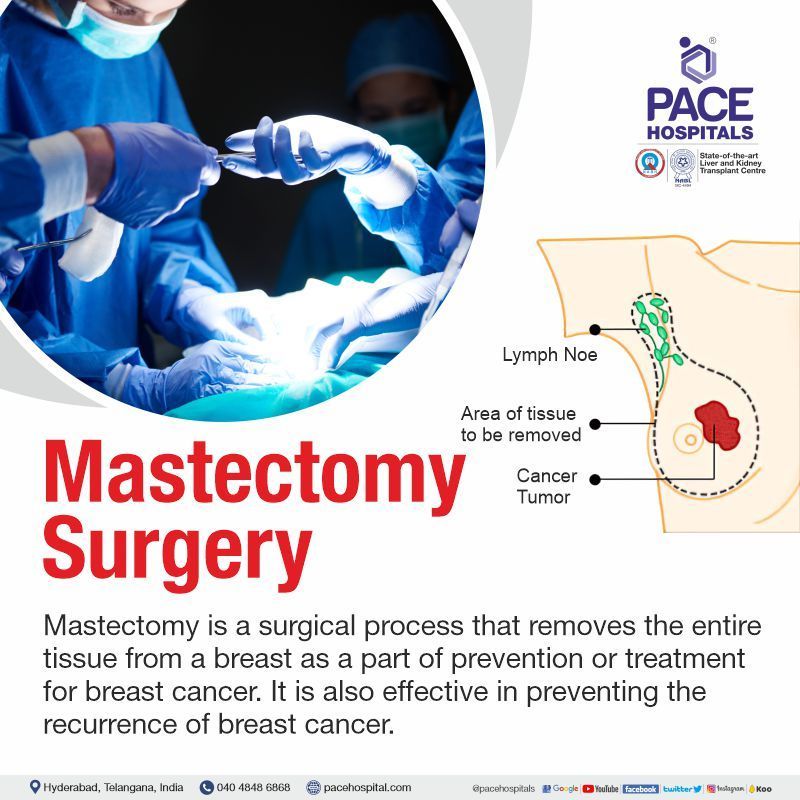 What is Mastectomy Surgery | Radical mastectomy surgery in India