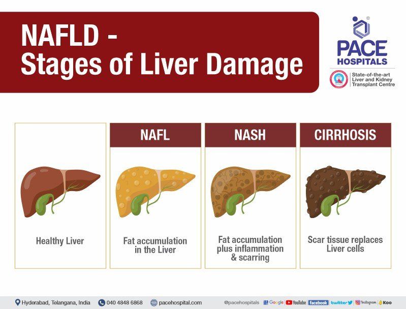 What is NAFLD, What is NASH