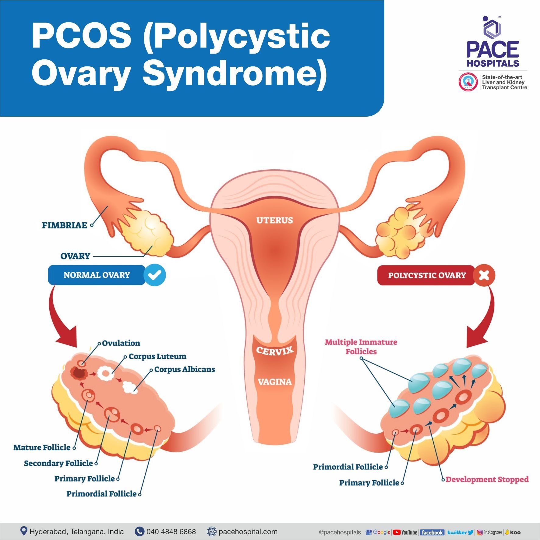 What is PCOS (Polycystic Ovary Syndrome), PCOD (Polycytic ovarian disease)