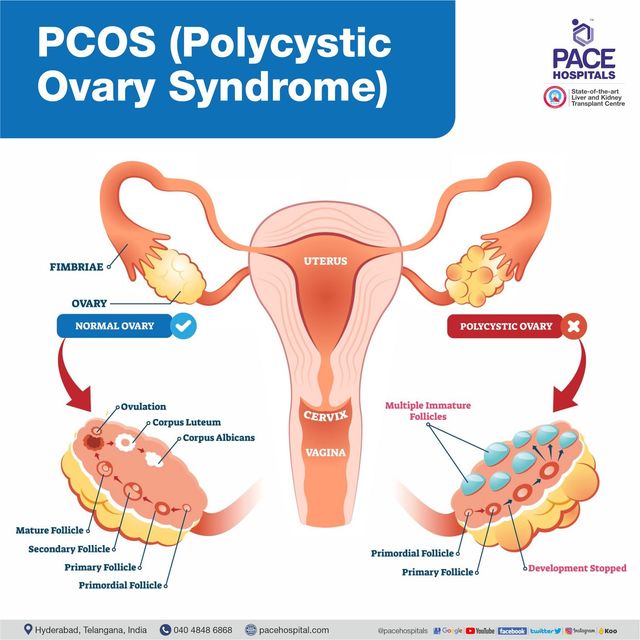 Meaning pcos The PCOS