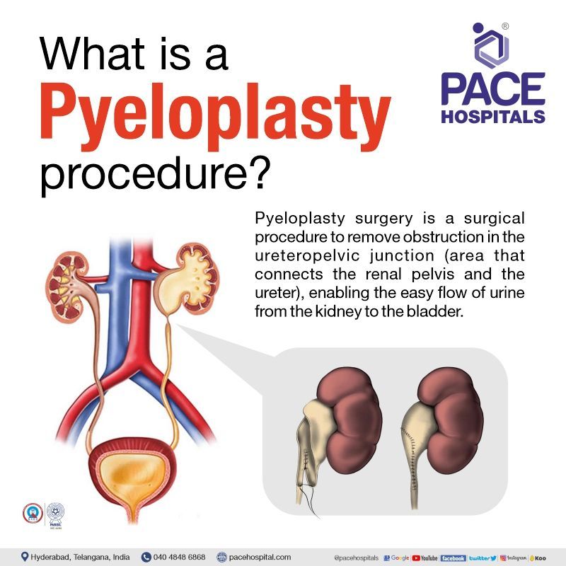 what is pyeloplasty procedure | pyeloplasty surgery in hyderabad | pyeloplasty surgery cost in India