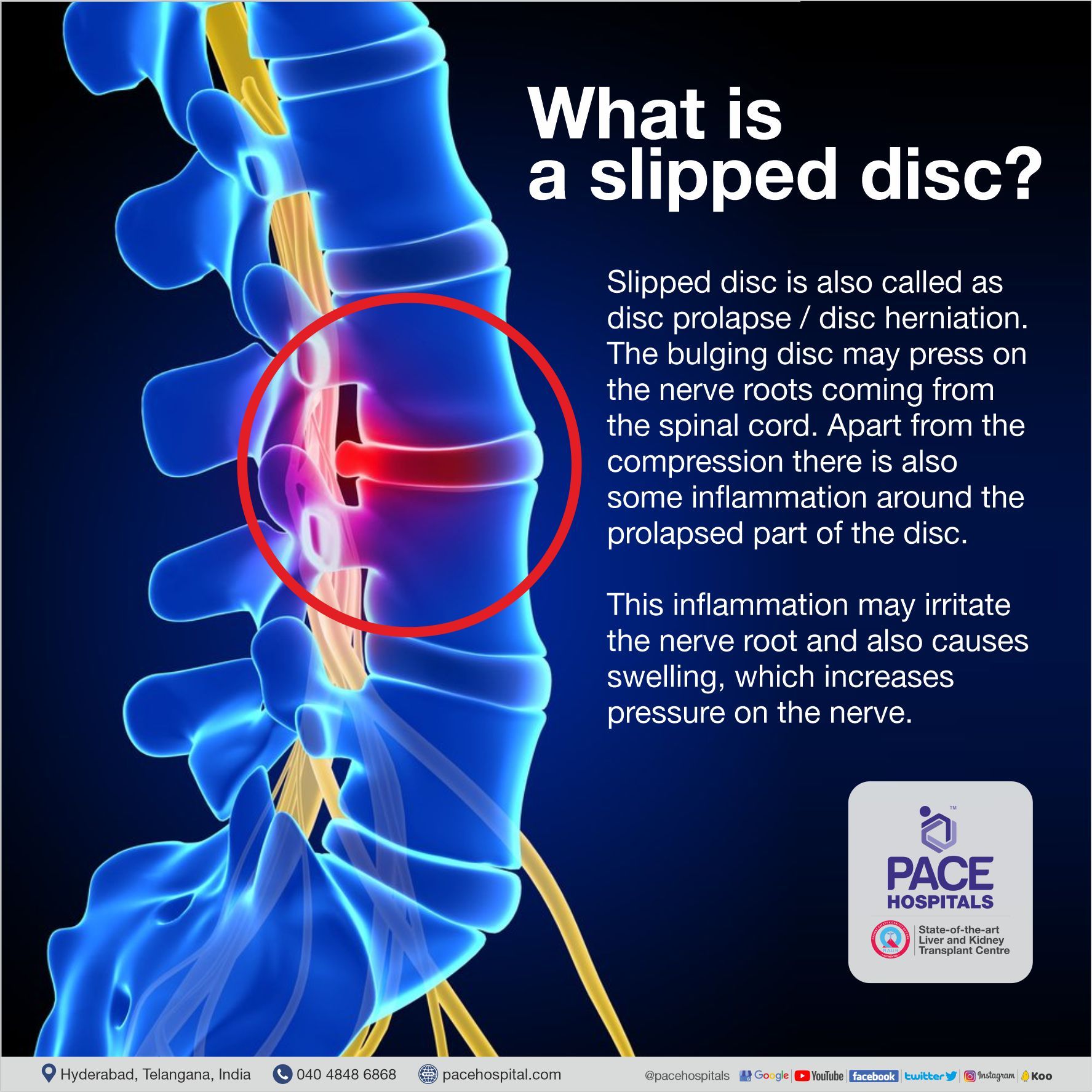 What is Slipped Disc - Definition