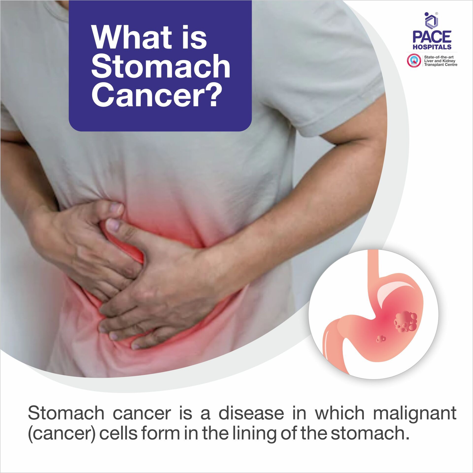 Stomach cancer treatment cost in Hyderabad | best stomach cancer hospital in Hyderabad