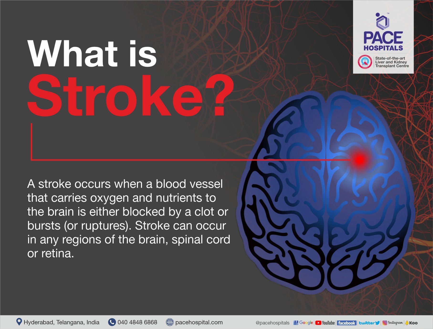 What is Stroke | Stroke and diet: An Indian Perspective