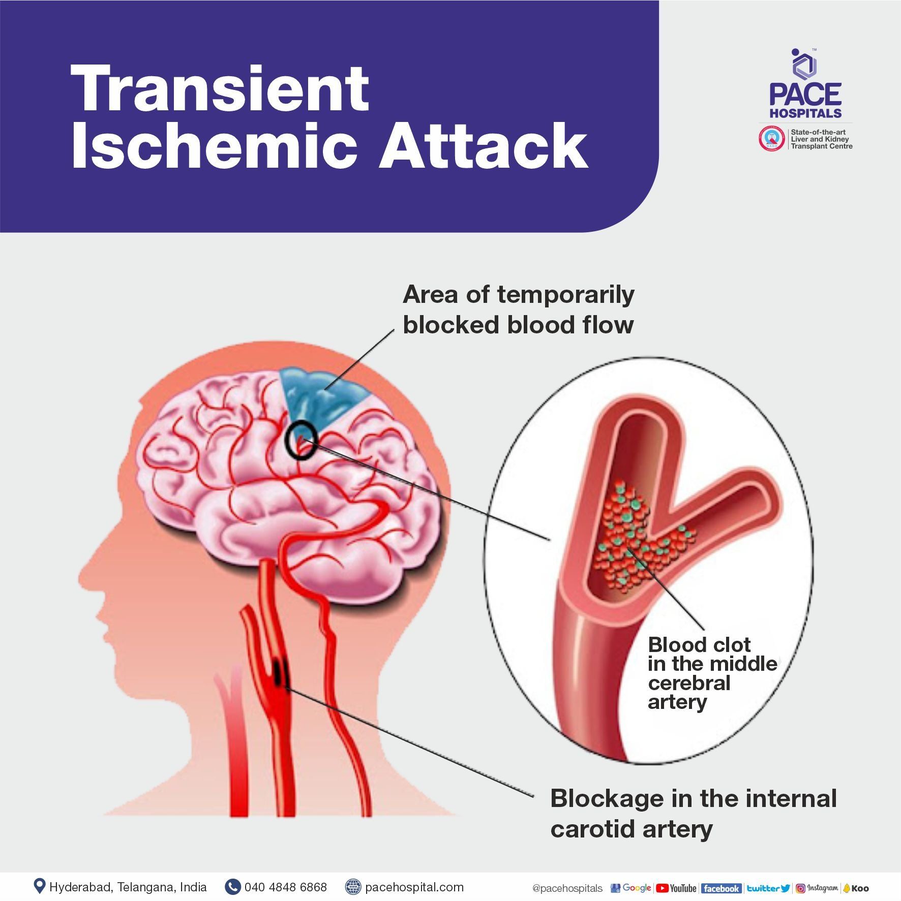 Types of Brain Stroke - transient ischemic attack (TIA)