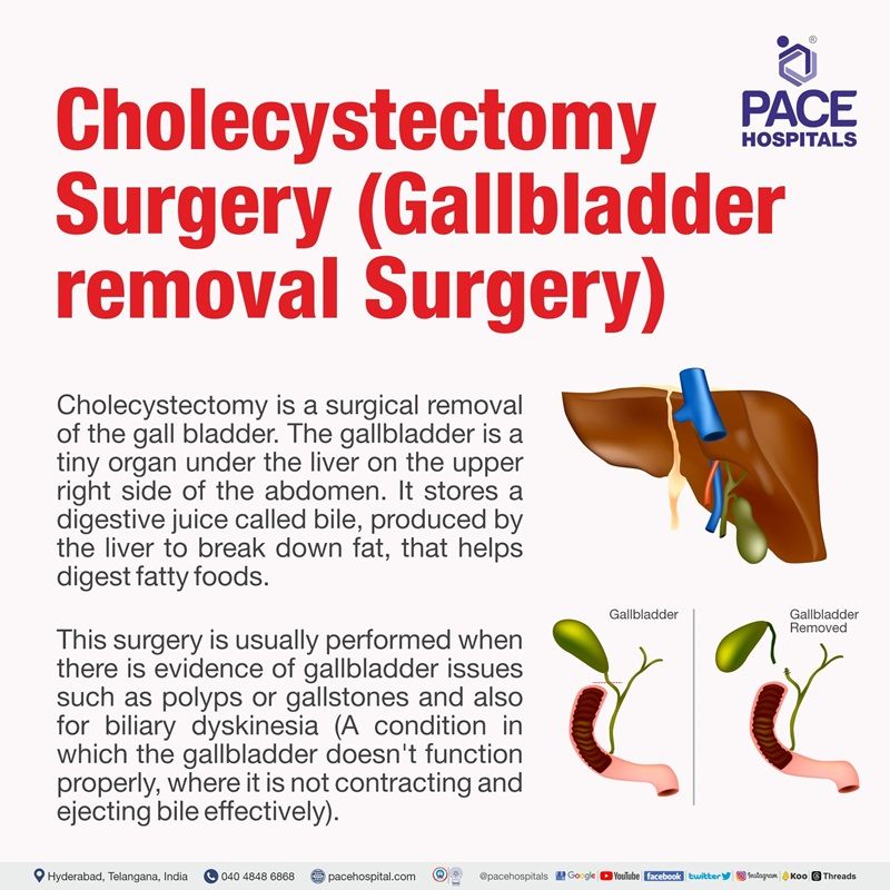 Gallbladder Removal Surgery in Hyderabad, India Cost & Side effects