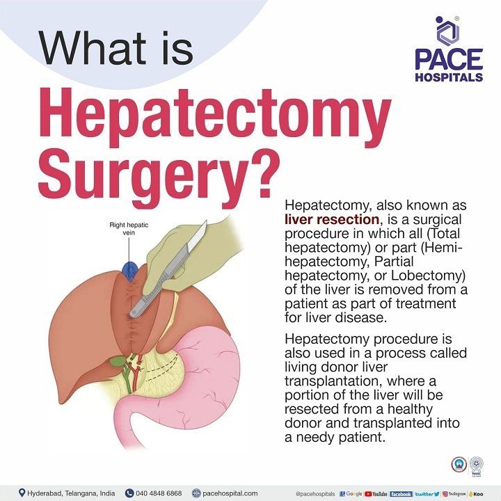 liver hepatectomy surgery in hyderabad | hepatectomy meaning | partial hepatectomy | segmental hepatectomy | total hepatectomy