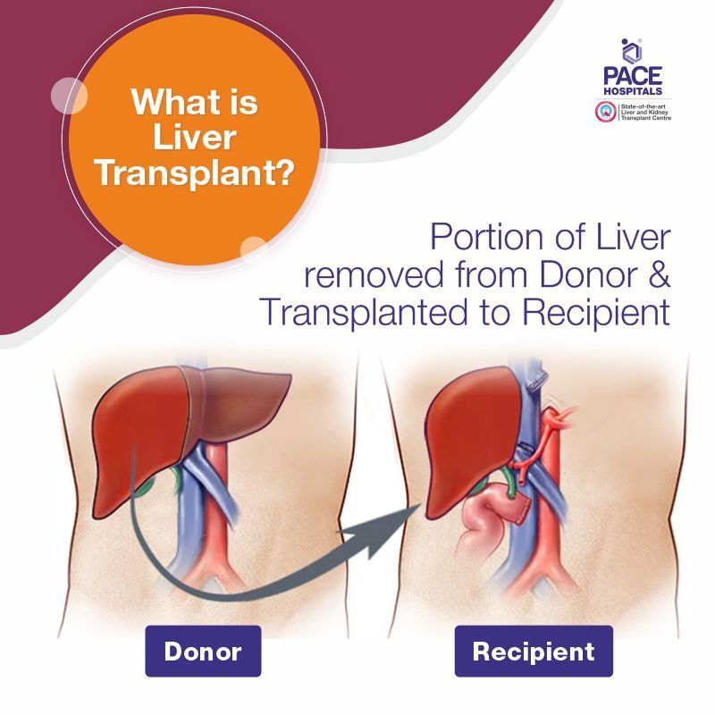 liver transplant cost in Hyderabad | Best liver transplant hospital in India