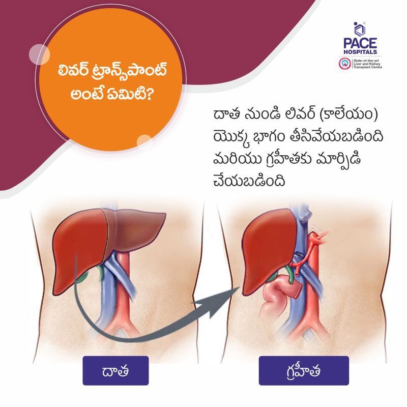 కాలేయ మార్పిడి అంటే ఏమిటి - Liver Transplant Cost in Hyderabad, India
