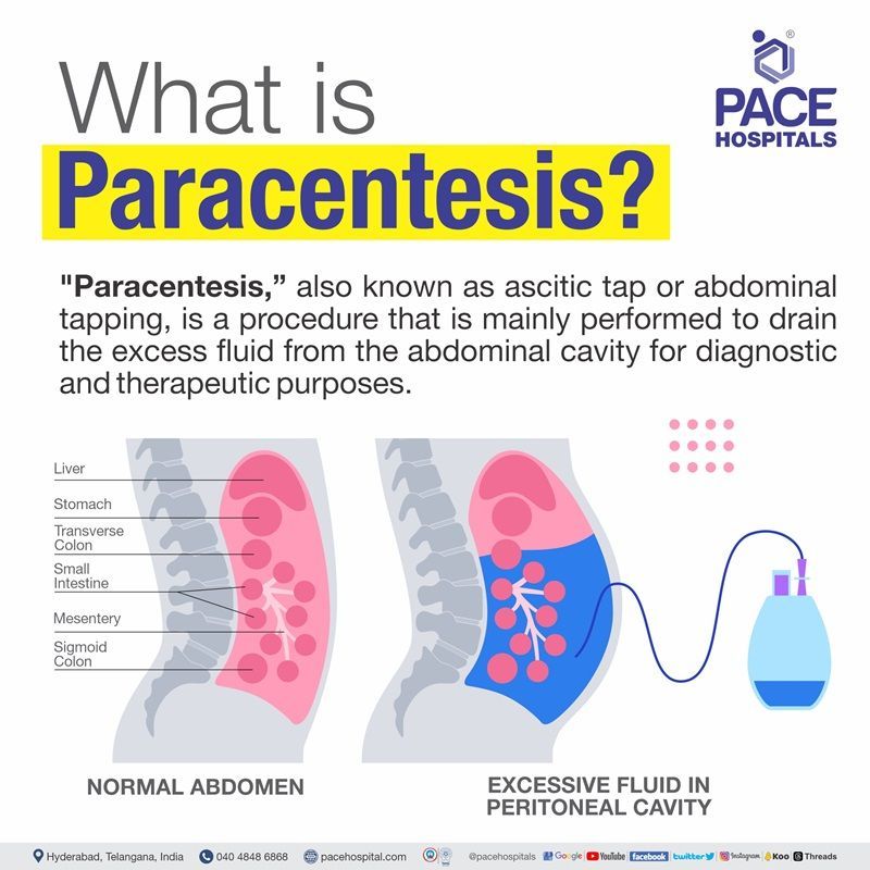 Best hospitals for paracentesis procedure in Hyderabad | paracentesis for ascites | abdominal paracentesis in Hyderabad, India | ascites tapping procedure in Hyderabad | paracentesis procedure near me