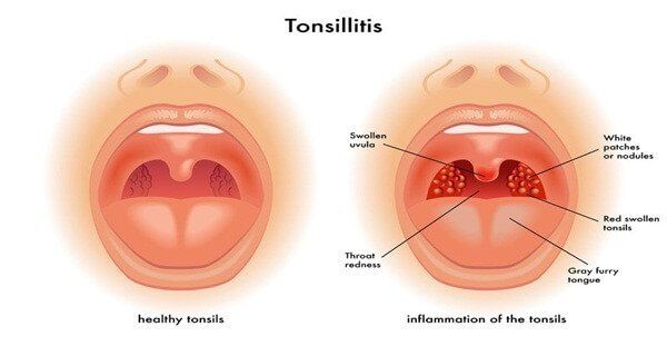 Tonsillitis is an infection of the tonsils