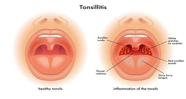 Tonsillitis chronica hypertrophica