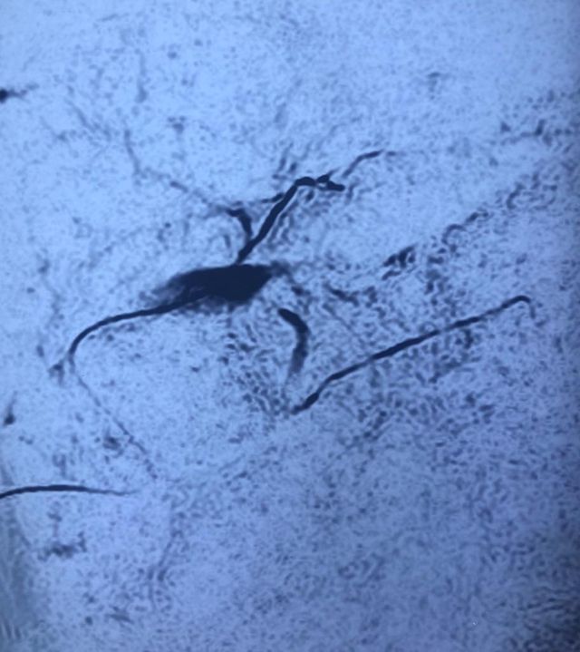 post cholecystectomy biliary stricture with complete cutoff and external biliary fistula