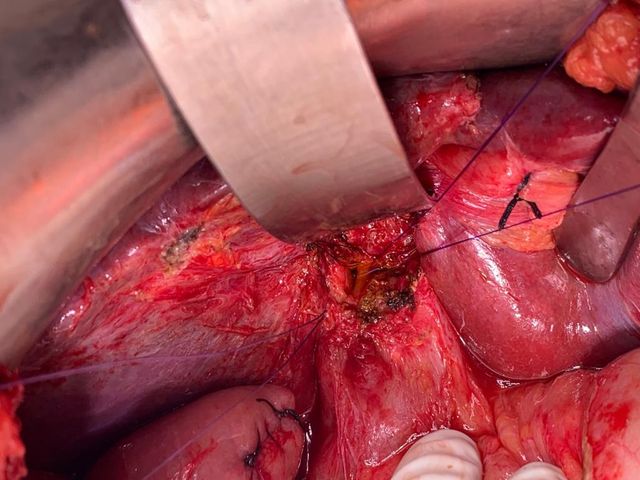 post cholecystectomy biliary stricture with complete cutoff and external biliary fistula