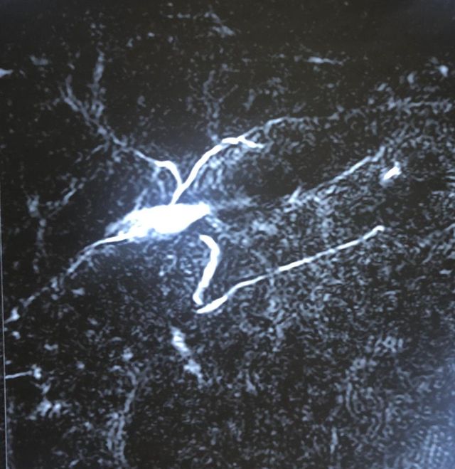 Afterwards cholecystectomy biliary stricture with complete cutoff and external biliary fistula
