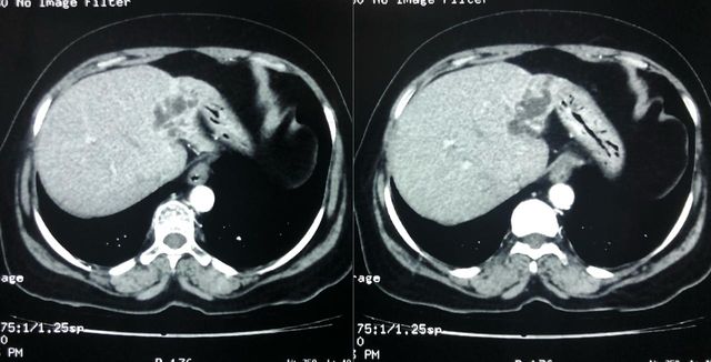 visual depicting Recurrent pyogenic cholangitis (RPC) with fever, jaundic and pain