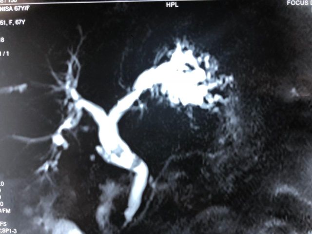 Recurrent pyogenic cholangitis treatment case study