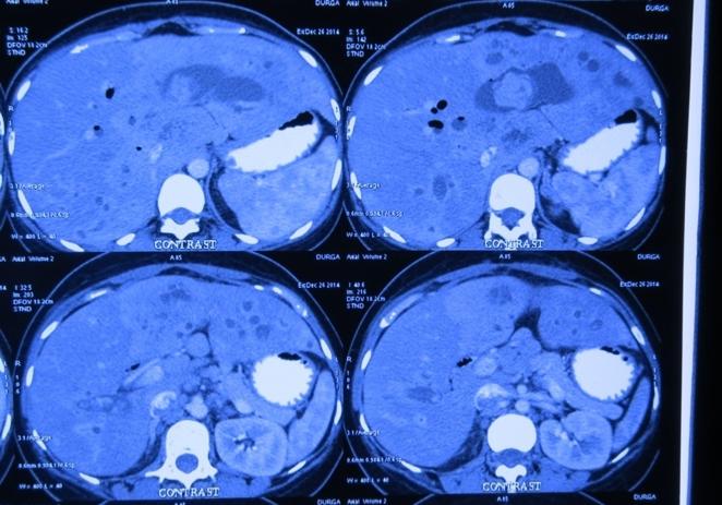 Recurrent pyogenic cholangitis (RPC) Treatment case study