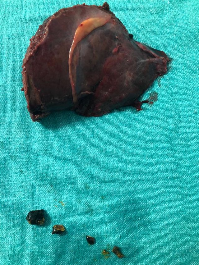 RPC with Jaundice and fever case study