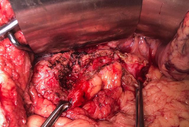 right hepatic artery Reconstruction was done by LPJ