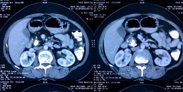  CT scan showed dilated PD 12 mm with large calculi