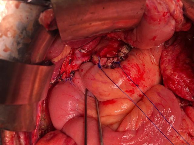 right hepatic artery Reconstruction was done by LPJ