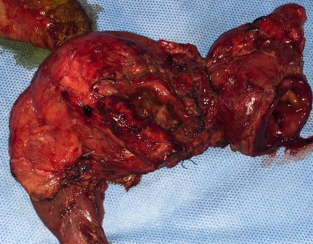 right hepatic artery Reconstruction was done by LPJ