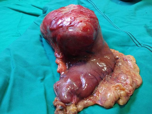 Gastric schwannoma is a very rare mesenchymal tumor