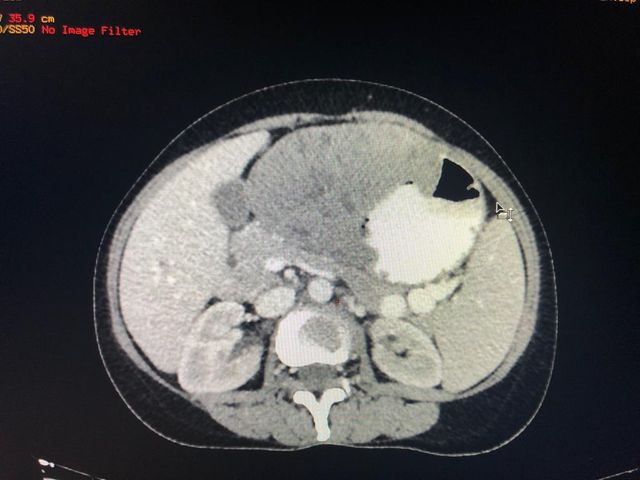 Gastric schwannoma is a very rare mesenchymal tumor