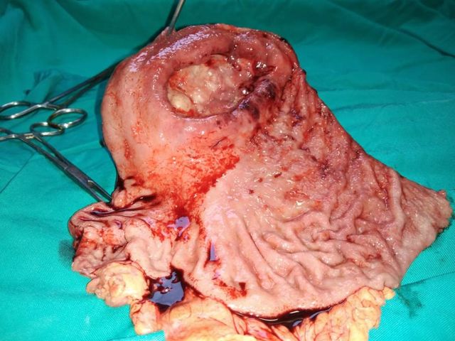 Gastric schwannoma is a very rare mesenchymal tumor