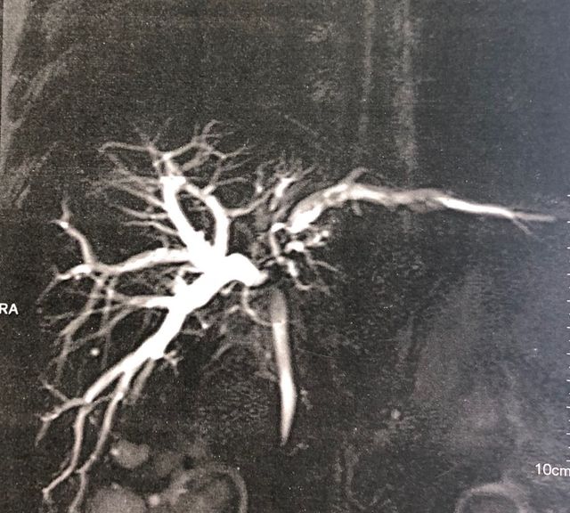 bile duct excision and right hepaticojejunostomy