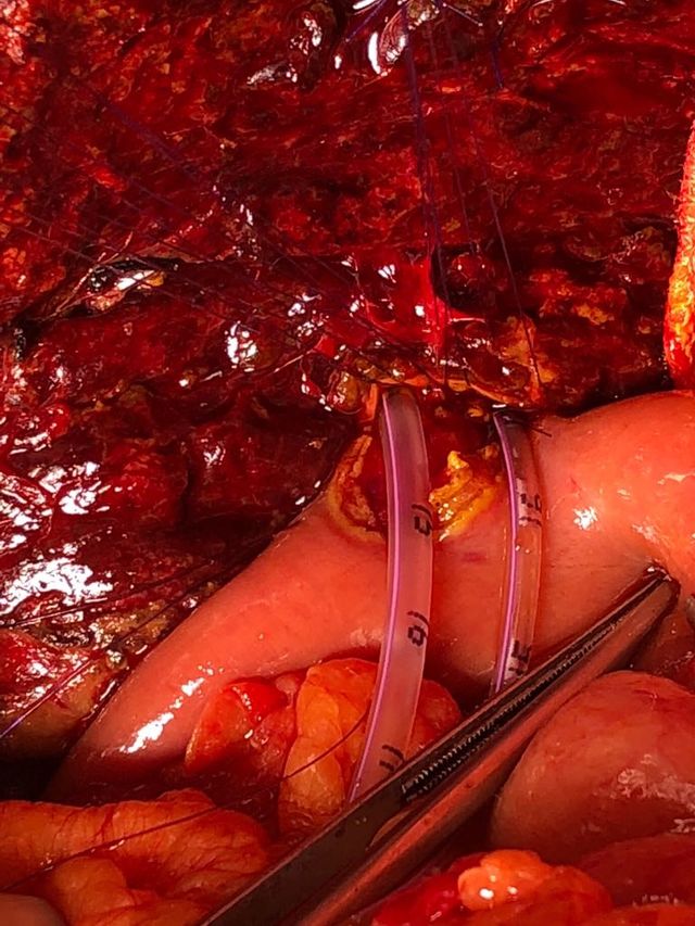 bile duct excision and right hepaticojejunostomy