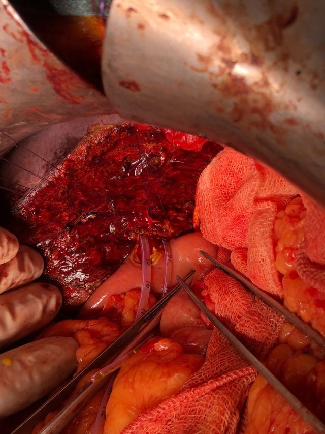 bile duct excision and right hepaticojejunostomy