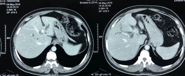 bile duct excision and right hepaticojejunostomy
