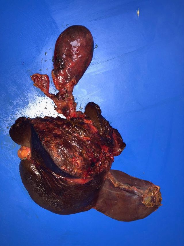 bile duct excision and right hepaticojejunostomy