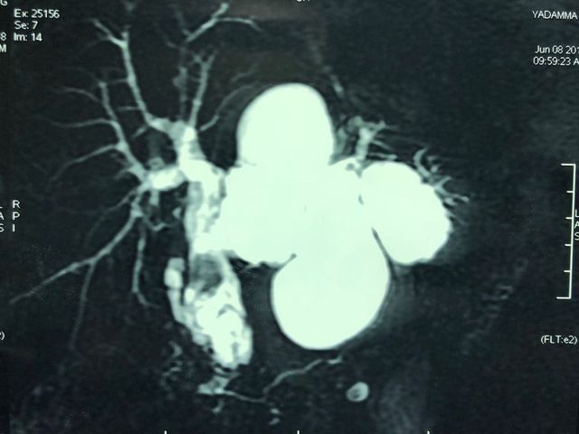 diagnosis of recurrent hydatid cyst